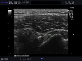Ultrazvok rame - kalcinacije v tetivi supraspinatusa, indikacija ESWT